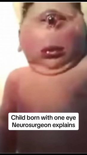 This is a rare defect where a child can be born with a conjoined eye and no midline features to the brain. 🧑‍⚕️ 🧠 #neurosurgery #neurosurgeon #holoprosencephaly #holoprosencephalyawareness #cyclopia #oneeye #geneticmutation #doctorexplains #medtok | Dr.Z Neurosurgery