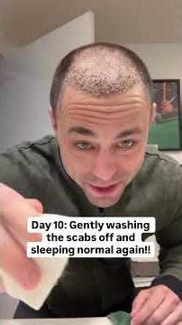 First 30 days of a Hair Transplant #funny
