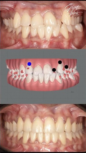 Crowded Teeth Corrected with Dental Clear Aligners - #invisalign #smilemakeover #clearaligners