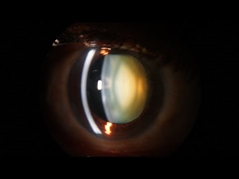 Slit Lamp examination of the anterior segment of the eye