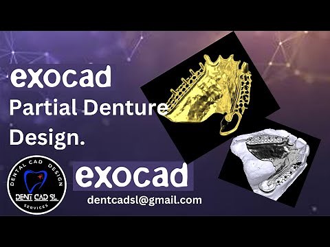 Exocad Partial Denture Design