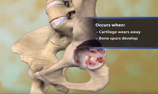 Osteoarthritis of the Hip Animation - OrthoInfo - AAOS
