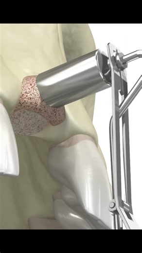 Dental implants are considered the superior because they look and function like natural teeth#viral