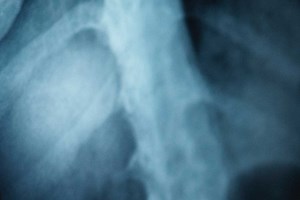 What Happens To Your Lungs When You Breathe Asbestos