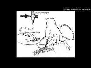 Percutaneous Transtracheal Jet Ventilation: Trachea