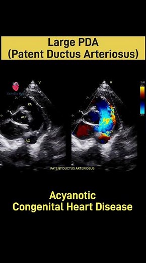 Large Patent Ductus Arteriosus (PDA) #EchoDxHub #LargePDA #PatentDuctusArteriosus #2DEcho