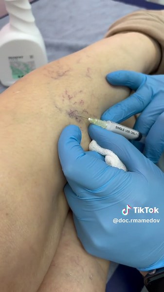 Leg Injection Procedure Explained by Medical Professional