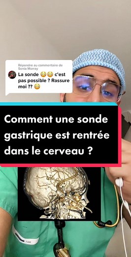 Réponse à @Sonia Morray ça reste une complication très rare mais possible. Malheureusement ça s'est terminé avec une hémorragie cérébrale. #surgery #viral #reponse #pourtoi #medical #chirurgie #maladie