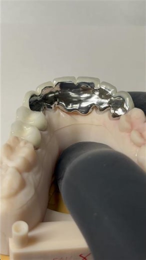 Metal ceramic bridge for Dr. Aaron McLemore in Michigan