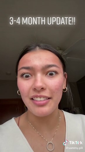 3-4 Month Skin Update with Aztec Secret Clay Mask | Acne Journey