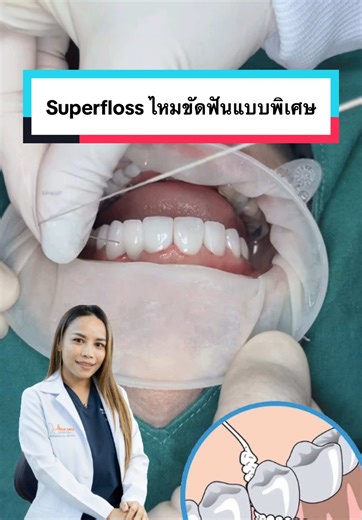 Superfloss: ไหมขัดฟันแบบพิเศษสำหรับทำความสะอาดสะพานฟัน