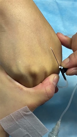 How to Give IV Inyección, Intravenous IV Inyección | Step-by-step Intravenous IV technique:N73