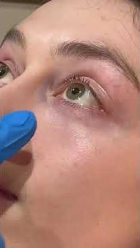 How to massage Tear Trough Filler