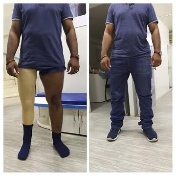 Hip Disarticulation Prosthesis