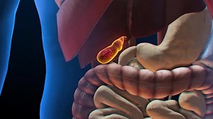 3D Animation of Gallbladder with Stones in Human Body
