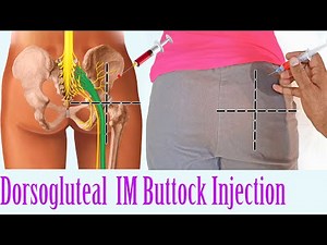 How to give an IM Intramuscular injection in the Buttocks | Hip Dorsogluteal Injection Technique