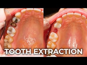 A Guide to Tooth Extraction | Restoring Your Oral Health with Precision and Care