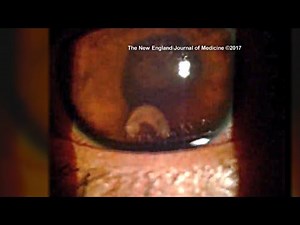 Parasitic Worm Found in Teen’s Eye