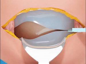 剖腹产如何进行的