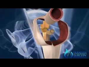 Iranian_surgery Sex Reassignment Surgery Educational Video