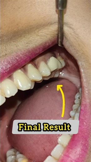 Root Canal Treatment & Capping 🔥💪#drshivamverma #dentist #rct #capping #shorts #dentalcaries