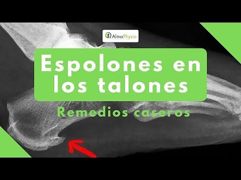 espolones en los talones remedios caseros