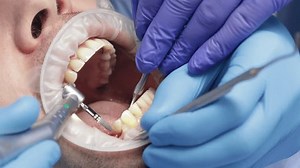 Dental Tooth Implantation Dental Surgeon Inserts Stock Footage Video (100% Royalty-free) 1108842307 | Shutterstock