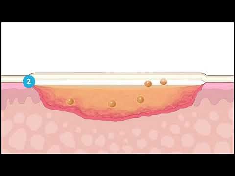 ADAPTIC™ COMO FUNCIONA