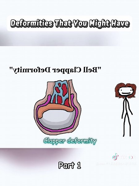 Exploring Common Deformities You Might Have - Part 1