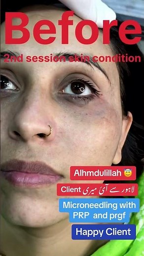 Results after Microneedling with PRP for Melasma ✅ #youtubeshorts #foryou #subscribe #drasifyasin
