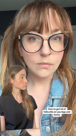 Chlorhexidine (Hibiclens) can help clear up & prevent recurrences of bacterial folliculitis. It is also useful as a foot and underarm wash to reduce odor. | Dr Dray