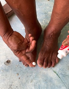 Elimina los molestosos hongos de los pies para siempre. | Recetas, Remedios y Mas