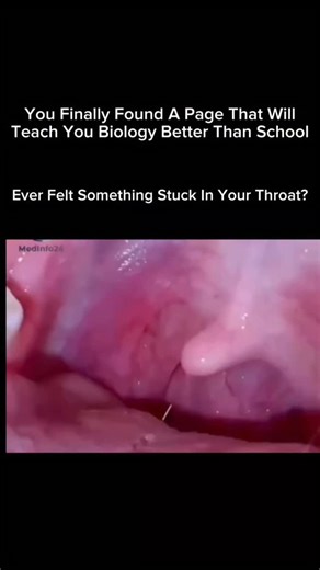 Explaining The Humans on Instagram: "Tonsil stones (tonsilloliths) form when debris—like food particles, mucus, dead cells, and bacteria—gets trapped in the small pockets of your tonsils. Over time, this buildup hardens into tiny, white or yellow, pebble-like stones. ✨ Why they happen: • Deep tonsil crypts (small pockets) • Post-nasal drip • Chronic inflammation • Poor oral hygiene • Large tonsils ✨ Common symptoms: • Bad breath (the most common sign) • White/yellow bumps on tonsils • Metallic t