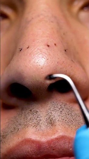 Full Face Blackhead Cleaning | Every Area Perfectly Done