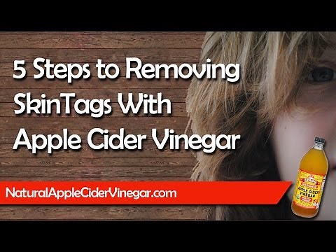 Using Apple Cider Vinegar to Remove Skin Tags in 5 Simple Steps