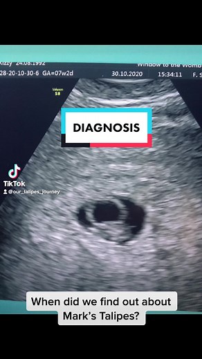 Our Talipes Journey on TikTok