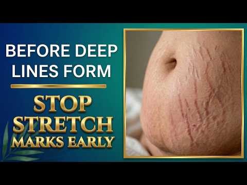 Stretch Marks: Causes, Prevention, and Medical Treatments