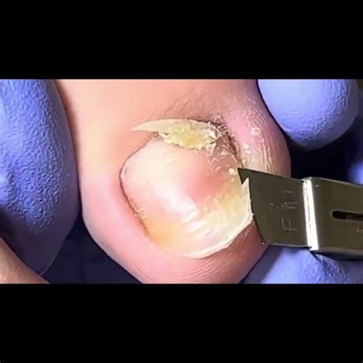 Satisfying pedicure video! #pedicure #toenails #satisfying #nails