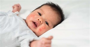 Alergia em bebês: saiba as principais causas de vermelhidão na pele