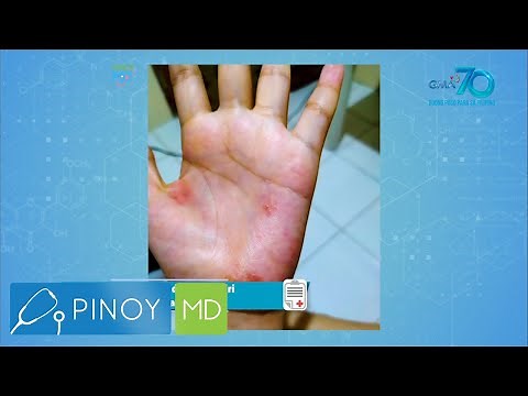Pinoy MD: Paano maiiwasan ang pangagati dulot ng eczema?