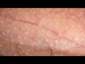 Learn about fordyce spots | what is adnexa