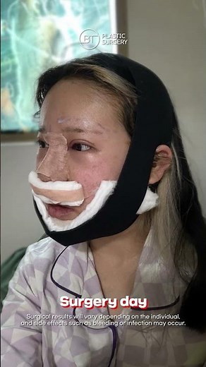 Korean Celebrity Plastic Surgery Before and After Pictures #koreaplasticsurgery