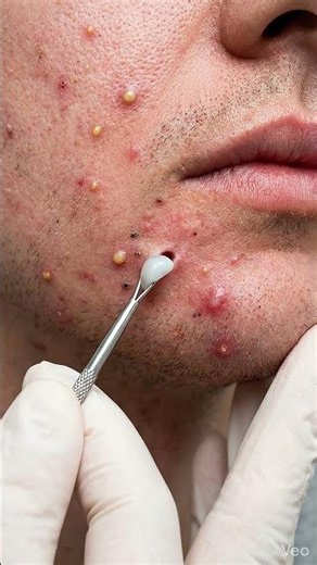 Intense Pimple Popping – Inflamed Acne Removal