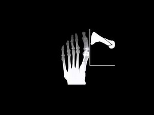 Bunion Surgery Austin with 2 Screws