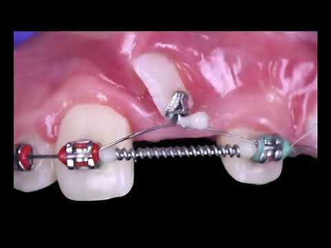 Braces to Pull Hidden Teeth | Orthodontic Treatment for Impacted Teeth