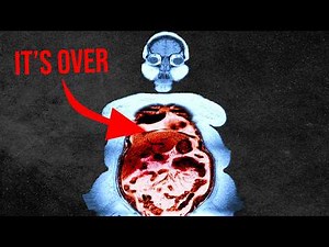 A woman took a friend's Ozempic and her entire gut was cooked