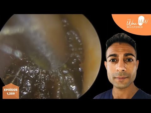 1,359 - Client with Blocked & Sticky Right Ear Every Morning after Waking Up