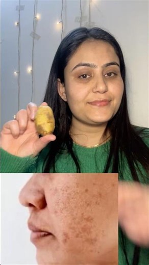Best and Easy Solution of Remove Pigmentation #skincare #diyskincare