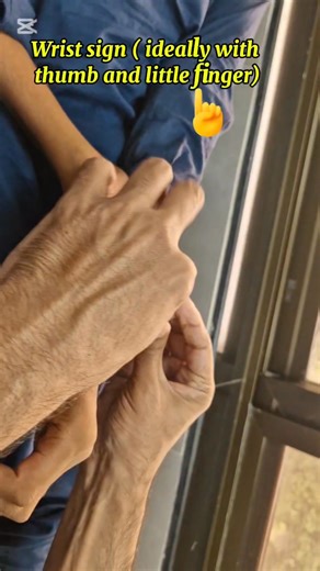 16K views · 136 reactions | Marfan syndrome, clinical signs ! | Dr. Arshad Mehmood - Child Specialist | Facebook