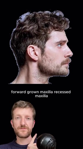 Hate to break it to you, but you can do all the gua sha, lymphatic drainage in the world, But if you dont have proper bone structure to support it, you will never get a sharp jawlineA recessed maxilla is the main cause of beauty loss.Hate your nose? Your jaw? Your cheekbones?It might not be genetics. It might be a recessed maxilla.All babies start with well-developed facial bones. But without the right muscle forces-like proper tongue posture, strong chewing, and nasal breathing-the maxilla begi